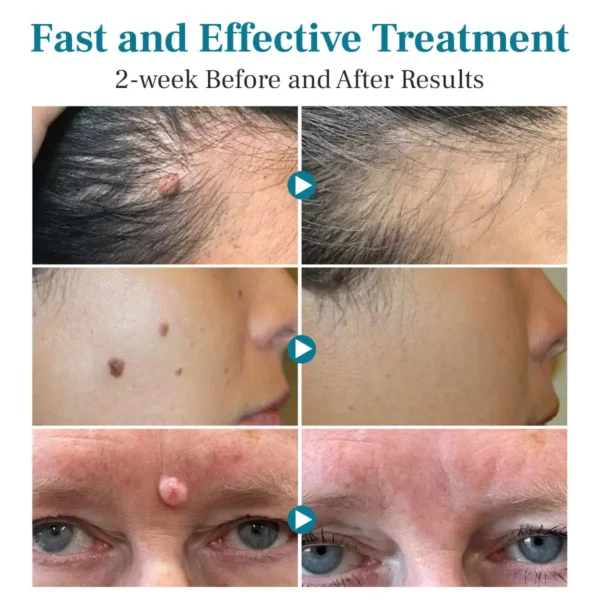 Curicreek® LumeSkin Mole and Wart Removal Laser Pen 2