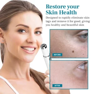 Curicreek® LumeSkin Mole and Wart Removal Laser Pen 2