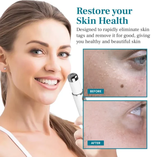 Curicreek® LumeSkin Mole and Wart Removal Laser Pen 2
