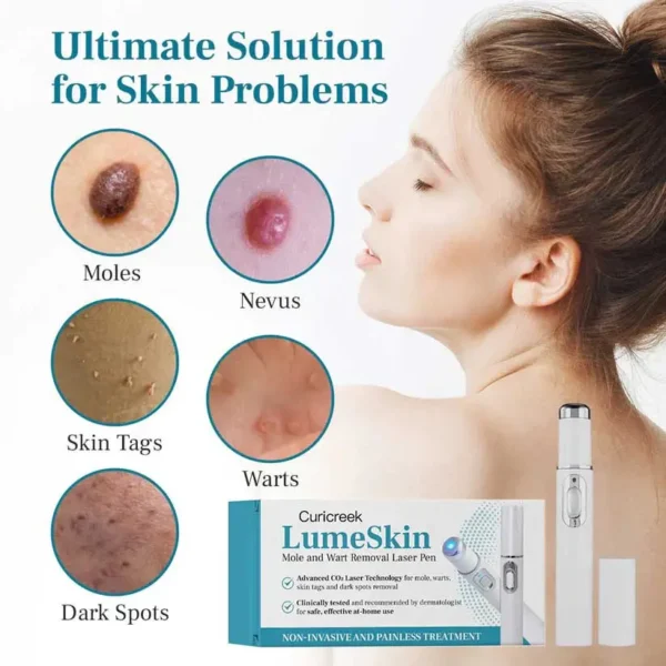 Curicreek® LumeSkin Mole and Wart Removal Laser Pen 2
