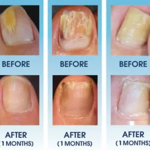 Curicreek® Nail Fungus Laser Treatment Device