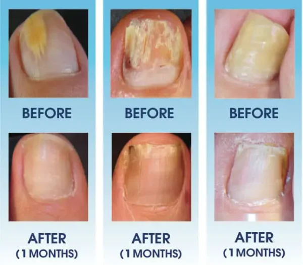 Curicreek® Nail Fungus Laser Treatment Device