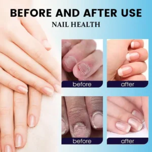 Curicreek® Nail Fungus Laser Treatment Device