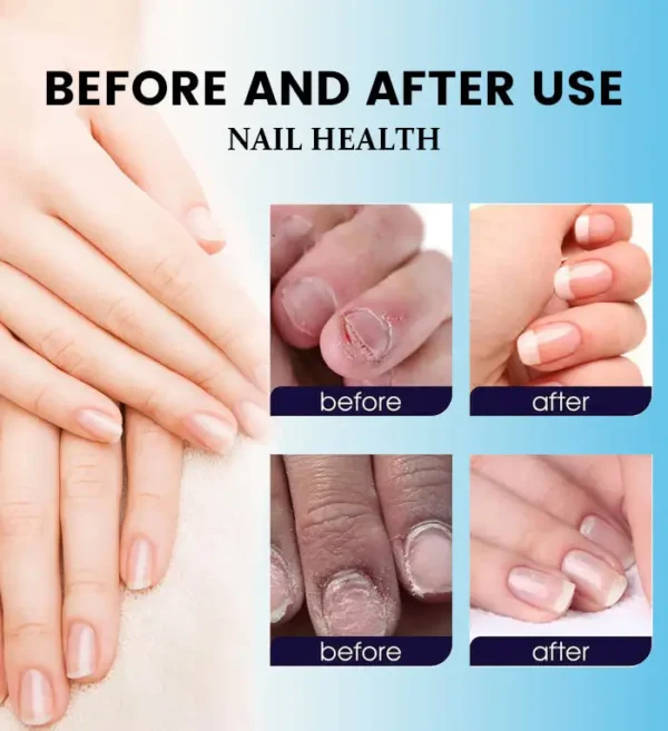Curicreek® Nail Fungus Laser Treatment Device