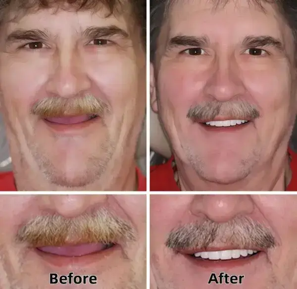 SmileFitPro™–Advanced Custom-Fit Functional Dentures